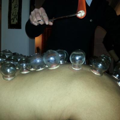 Ventouses à chaud - cupping therapy